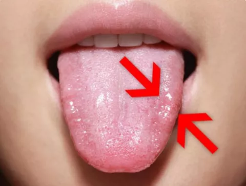 Hongos en la lengua Hongos en la lengua