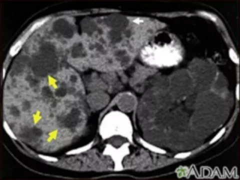 Poliquistosis renal Poliquistosis renal