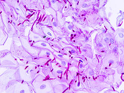 Candidiasis esofágica