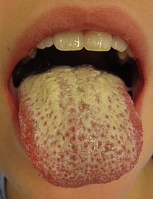 Candidiasis oral