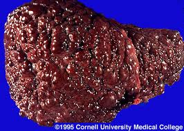 Fotografía de un hígado cirrótico