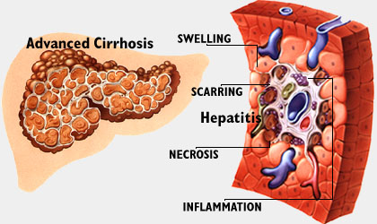 Dibujo de un hígado cirrótico y dibujo del hígado cortado tranversalmente mostrando fibrosis, necrosis e inflamación