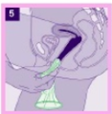 Dibujo de la vagina en un corte transversal mostrando el interior de la mujer introduciendose el aro interior del preservativo femenino