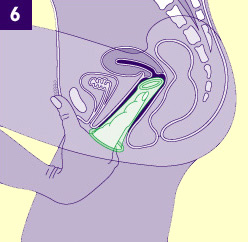 Dibujo un corte tranversal del interior de la vagina con un preservativo introducido en el interior impulsado por el dedo