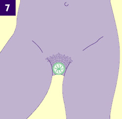 Dibujo mostrando la vagina con el preservativo introducido y saliendo el aro exterior