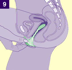 Dibujo del corte transversal de la vagina mostrando el interior y con la mano enrollando el preservativo