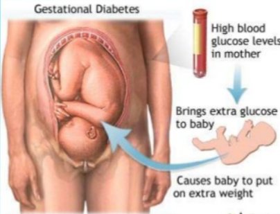Dibujo de un bebé en desarrollo dentro del útero.